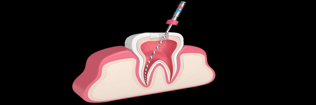 root-canal-service-banner-1